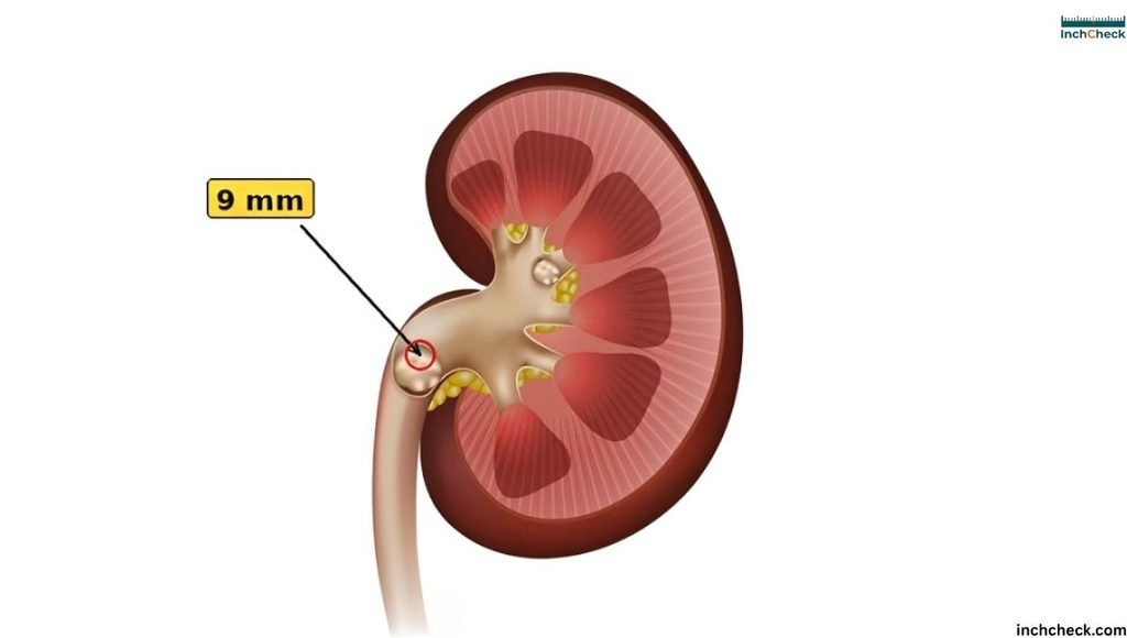 How Big Is 9mm Kidney Stone?